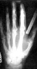 Рентгеновский снимок кисти руки